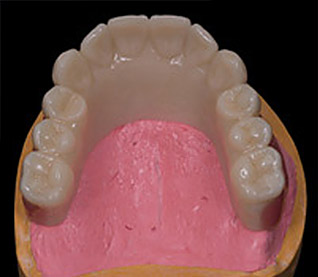 Hannker Dental NEM-Cobaltchrom mit Überwurf