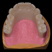 Hannker Dental NEM-Cobaltchrom mit Überwurf