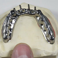 Hannker Dental Titanstege mit Überkonstruktion